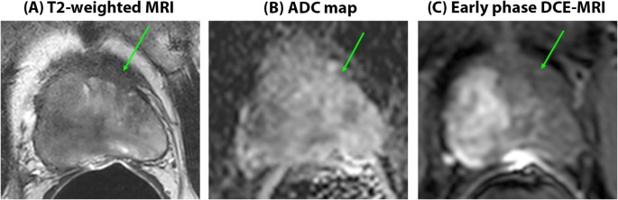 Calcified nodule in prostate