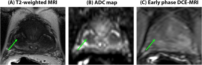 prostate mri pitfalls ajr