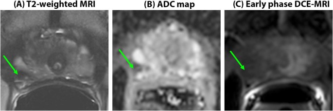 Calcified nodule in prostate. Adenocarcinoma gyógyulási esélyek