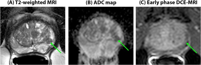 prostate cancer mri pitfalls)