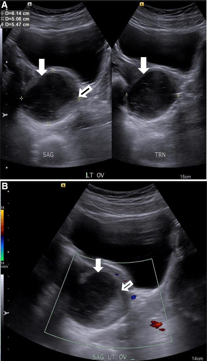 Imaging In Pediatric Ovarian Tumors Springerlink