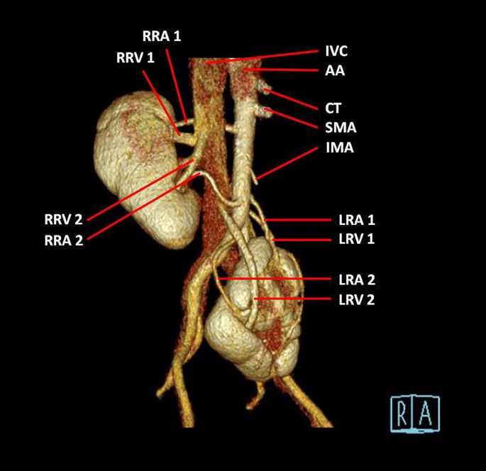 Evaluating The Origin Of Vascular Structures In Ectopic Kidneys With Multidetector Computed Tomography Springerlink