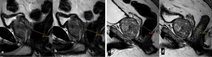 prostate mri fleet enema