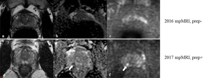 prostate mri fleet enema