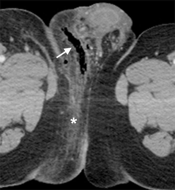 Image: Fournier Gangrene (X-Ray) - Merck Manuals Professional Edition