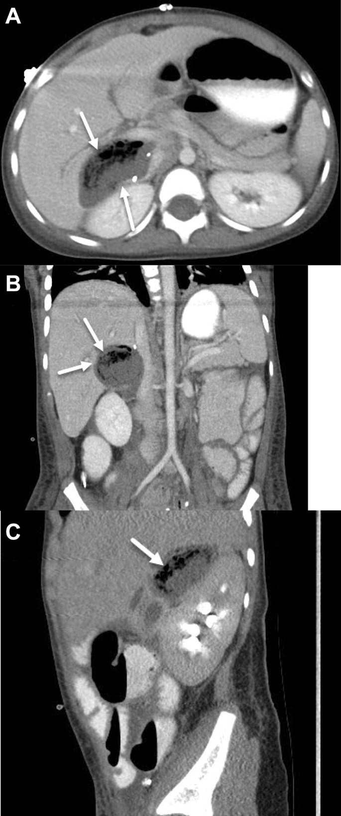 Morison's pouch: anatomical review and evaluation of pathologies and  disease spread on cross-sectional imaging | Abdominal Radiology