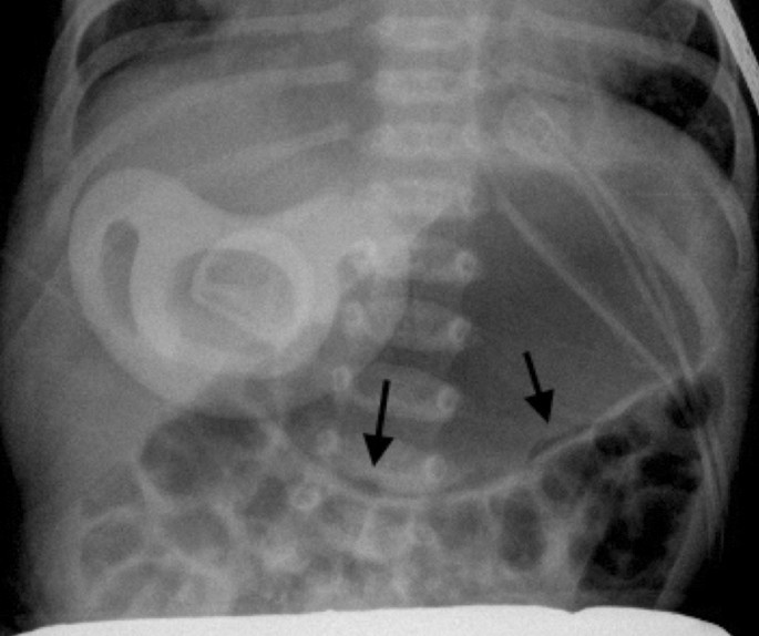 Intestinal Pneumatosis Differential Diagnosis Springerlink