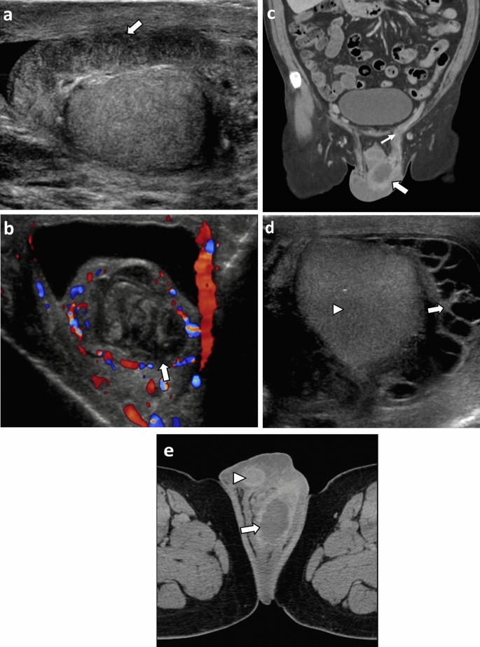 Imaging Spectrum Of Common And Rare Infections Affecting The Lower Genitourinary Tract Springerlink