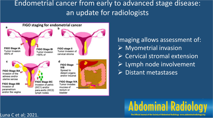 Endometrial cancer from early to advanced-stage disease: an update for  radiologists | SpringerLink