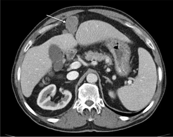 Malignant Peritoneal Mesothelioma Correlation Between Ct Imaging Features And Histologic Subtypes Springerlink