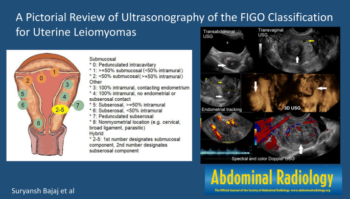 A pictorial review of ultrasonography of the FIGO classification for  uterine leiomyomas | SpringerLink