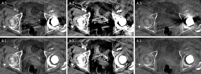 Metal implants on abdominal CT: does split-filter dual-energy CT provide  additional value over iterative metal artifact reduction? | Abdominal  Radiology