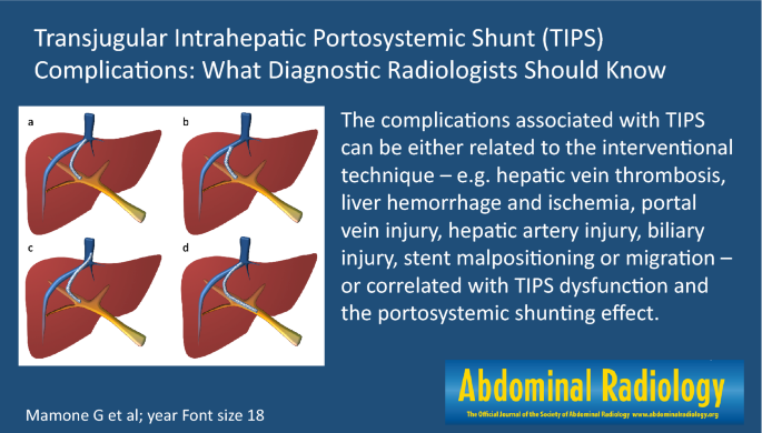 Transjugular Intrahepatic Portosystemic Shunt (Tips) Complications: What  Diagnostic Radiologists Should Know | Springerlink