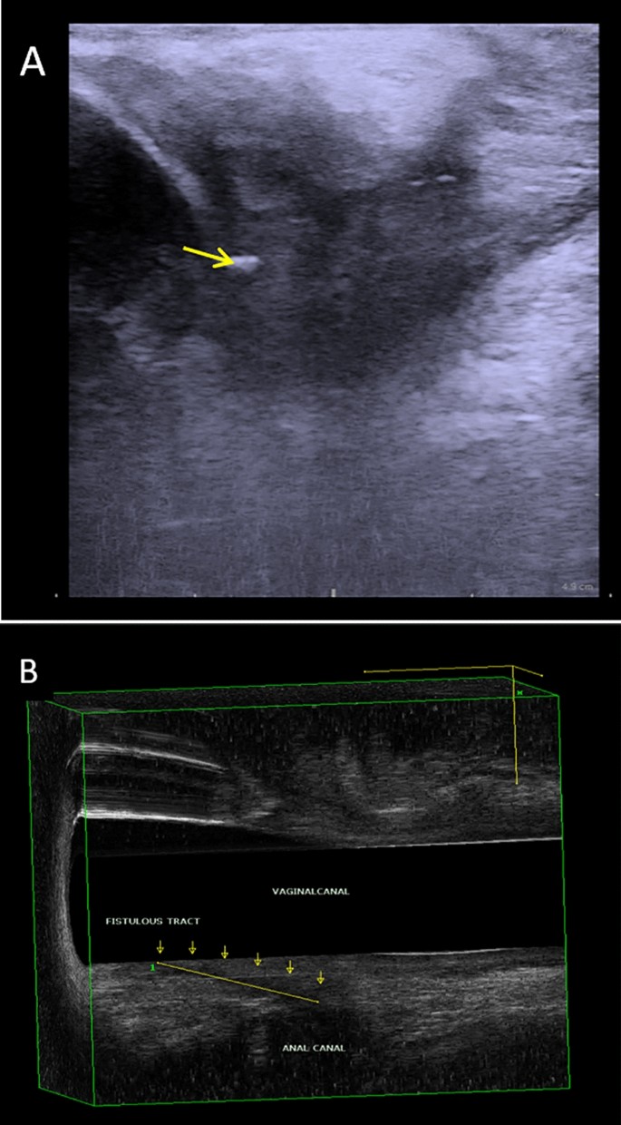 Current update on the role of endoanal ultrasound: a primer for  radiologists | Abdominal Radiology | Springer Nature Link