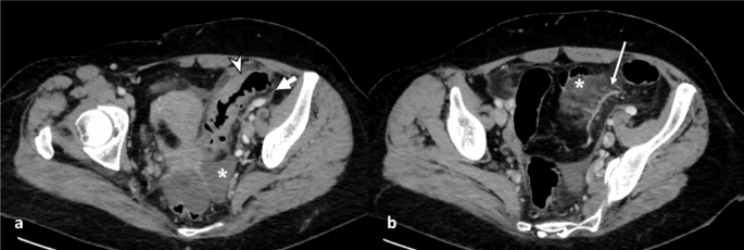 The “centipede” sign | Abdominal Radiology | Springer Nature Link