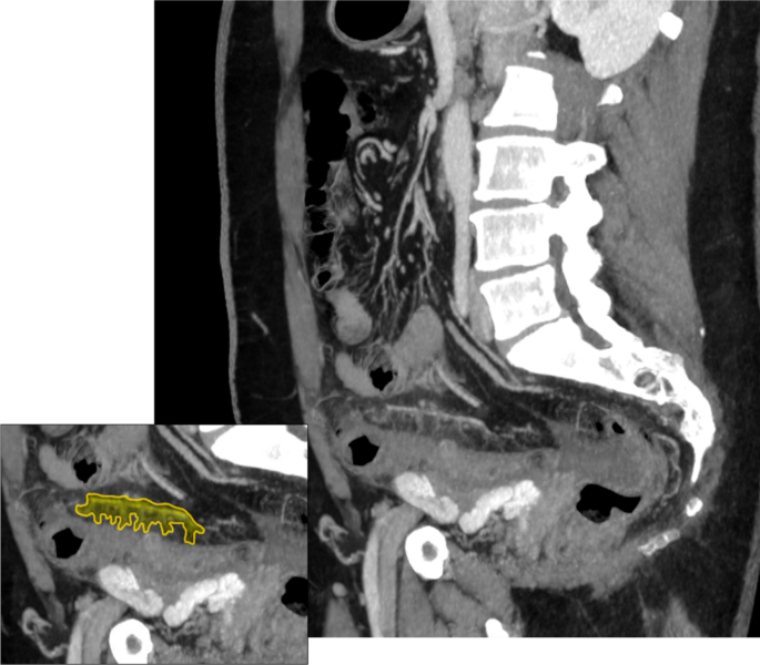 The “centipede” sign | Abdominal Radiology | Springer Nature Link