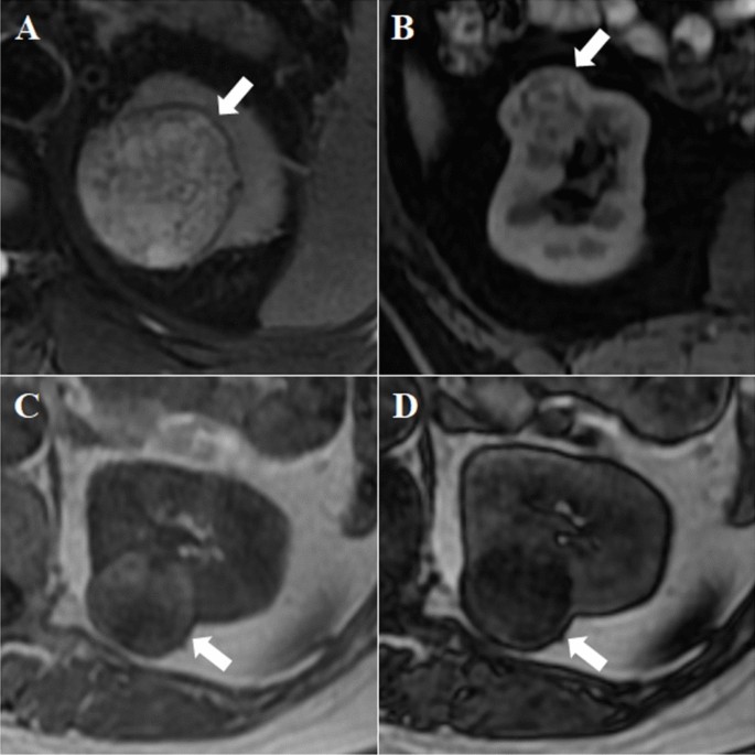A simple method based on qualitative MRI features for characterizing ...