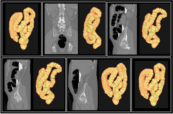 Colon Clip CT colonography for longitudinal in-vivo assessment of colonic ...