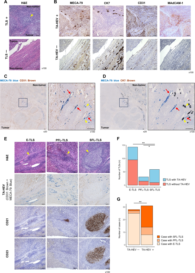 Tumor-associated high endothelial venules are associated with enhanced ...