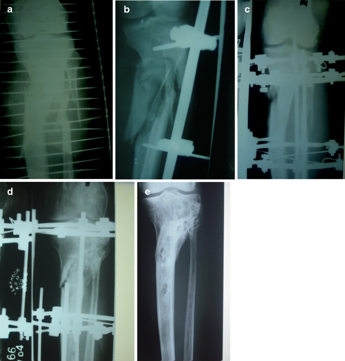 A Novel technique of three-ring Ilizarov fixator frame in gap non-union of  tibia - ScienceDirect