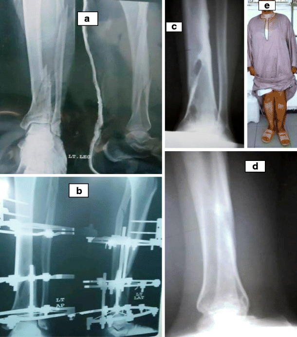 Full ring external fixation (Ilizarov) for Extraarticular, wedge fracture