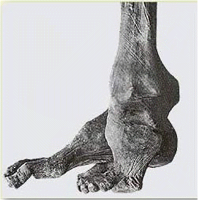 History Of Clubfoot Treatment Part I From Manipulation In Antiquity To Splint And Plaster In Renaissance Before Tenotomy Springerlink