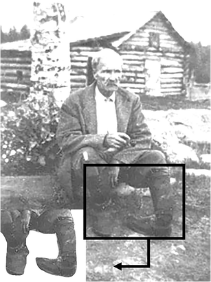 History Of Clubfoot Treatment Part Iii Twentieth Century Back To The Future Springerlink