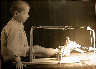 History Of Clubfoot Treatment Part Iii Twentieth Century Back To The Future Springerlink