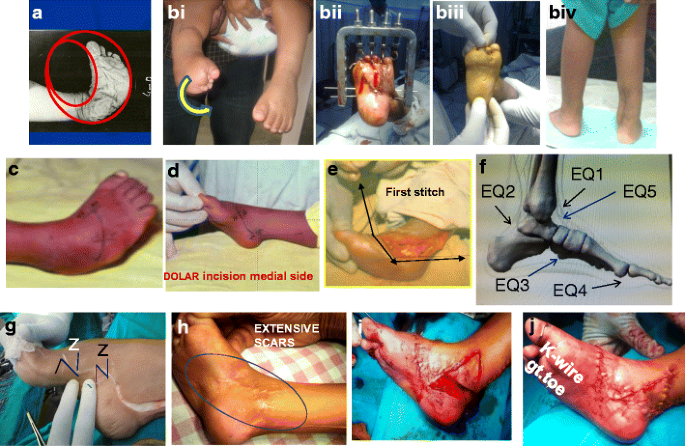 Trimorphic extreme clubfoot deformities and their management by triple  surgical skin expanders- DOLAR, DOLARZ and DOLARZ-E (evidence based  mega-corrections without arthrodesis) | SpringerLink
