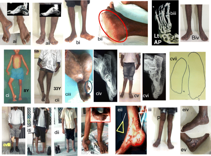 Trimorphic Extreme Clubfoot Deformities And Their Management By Triple Surgical Skin Expanders Dolar Dolarz And Dolarz E Evidence Based Mega Corrections Without Arthrodesis Springerlink