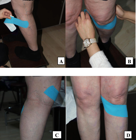 Mobilization with movement and kinesio taping in knee arthritis—evaluation  and outcomes | SpringerLink
