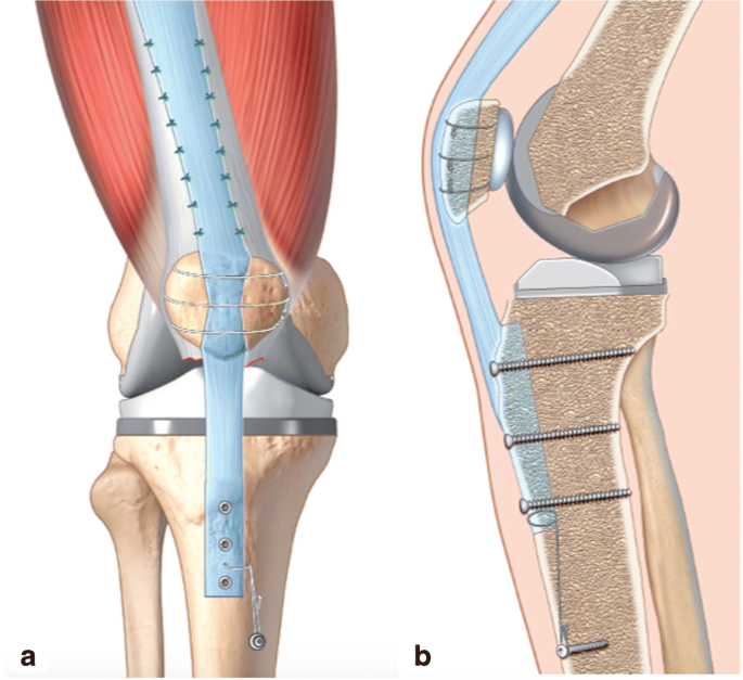 Partial extensor mechanism allograft reconstruction for chronic patellar  tendon disruption shows superior outcomes in native knees when compared to  same technique following total arthroplasty | SpringerLink