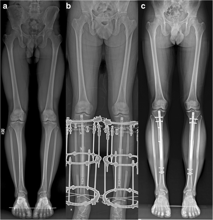 Functional recovery of daily living and sports activities after cosmetic  bilateral tibia lengthening | SpringerLink