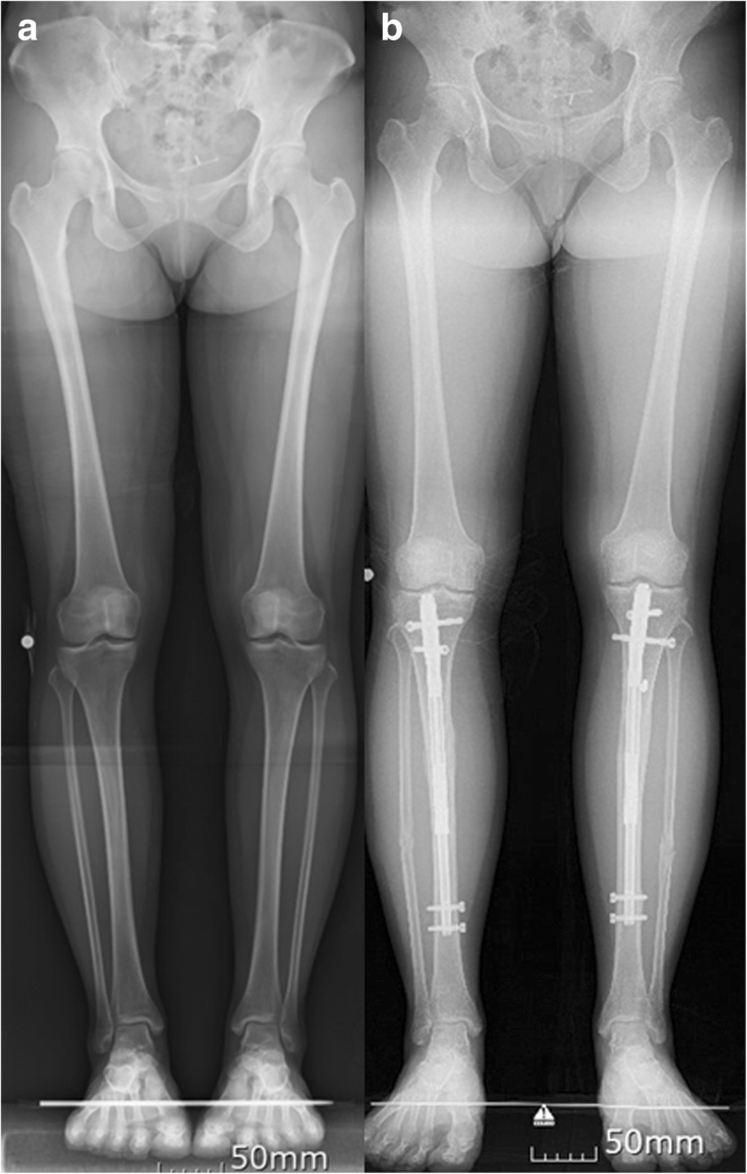Functional recovery of daily living and sports activities after cosmetic  bilateral tibia lengthening | SpringerLink