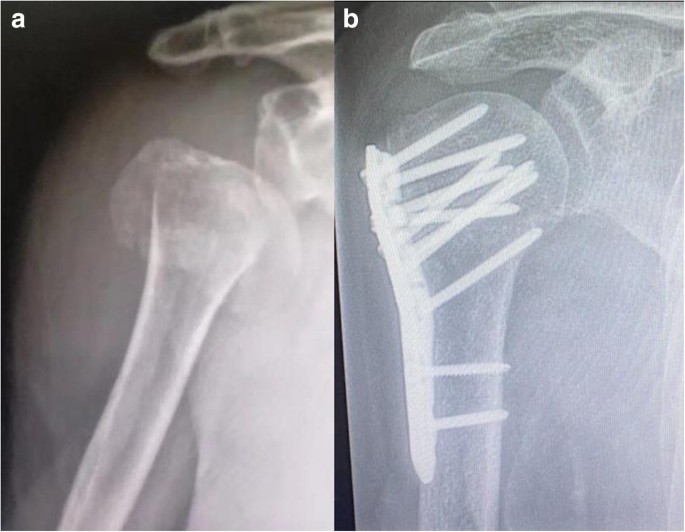 The Plate Fixation Strategy Of Complex Proximal Humeral Fractures Springerlink