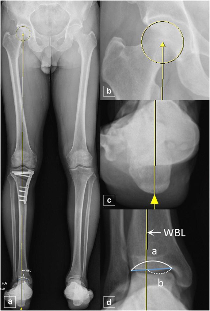 Change in the weight-bearing line ratio of the ankle joint ...