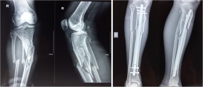 A Review of Proximal Tibia Entry Points for Intramedullary Nailing