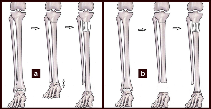 Analysis of bone transport for ankle arthrodesis as a limb salvage  procedure for the treatment of septic pilon fracture nonunion