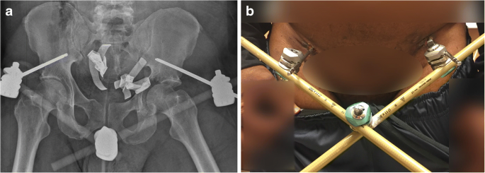 Comparison of iliac crest versus supraacetabular external fixator in  hemodynamically unstable patients with a pelvic ring injury | SpringerLink