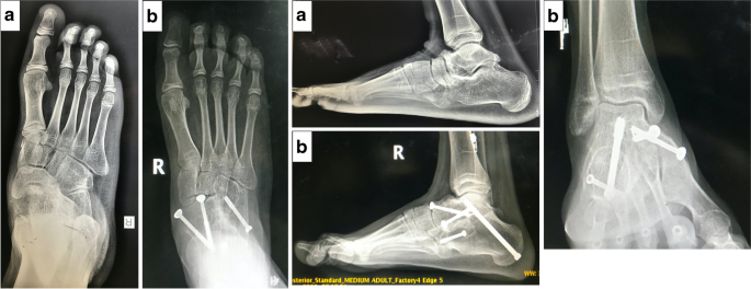 Double versus triple arthrodesis for adult-acquired flatfoot deformity due  to stage III posterior tibial tendon insufficiency: a prospective  comparative study of two cohorts | SpringerLink