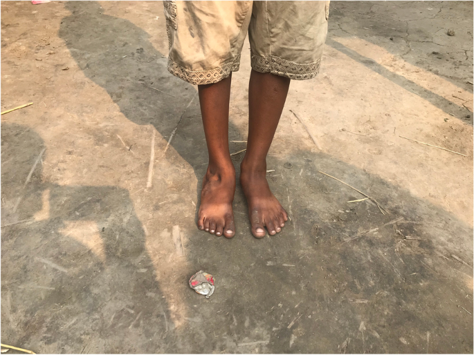 Evaluation Of A Surgical Treatment Algorithm For Neglected Clubfoot In Low Resource Settings Springerlink
