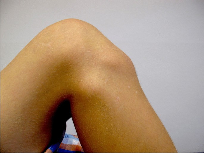 The Osgood-Schlatter disease: a large clinical series with evaluation of  risk factors, natural course, and outcomes | SpringerLink