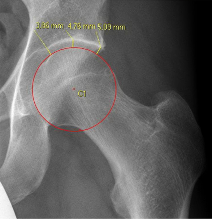 The lateral joint space width is essential for the outcome after  arthroscopically assisted mini-open arthrotomy for treatment of a  femoroacetabular impingement: an analysis of prognostic factors for the  success of this hip-preserving