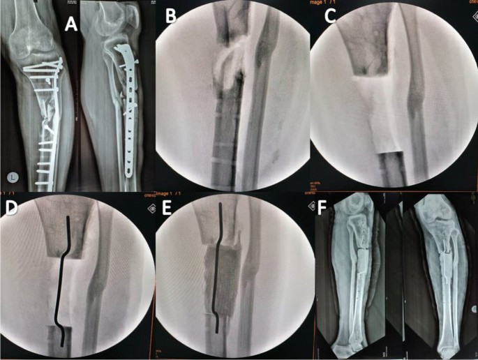 Masquelet–Ilizarov technique for the management of bone loss post 