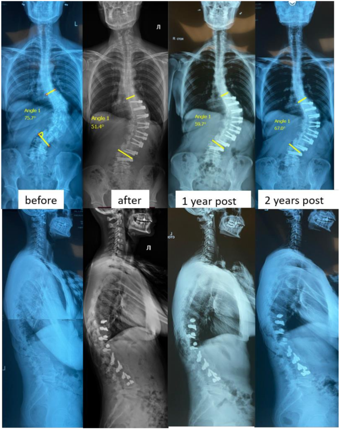Anterior scoliosis correction in patients over forty years: results ...