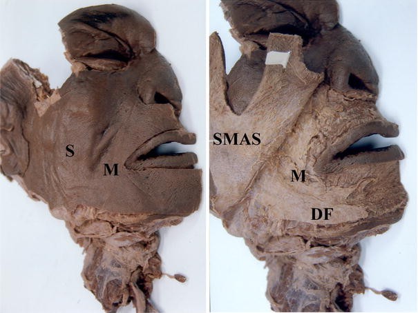 An Anatomical And Analytical Study Of The Modiolus Enlightening Its Relevance To Plastic Surgery Springerlink