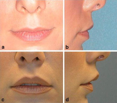 The No-Scar Lip-Lift: Upper Lip Suspension Technique | SpringerLink