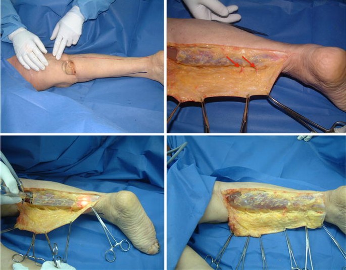 Calf Implants A 25 Year Experience And An Anatomical Review Springerlink