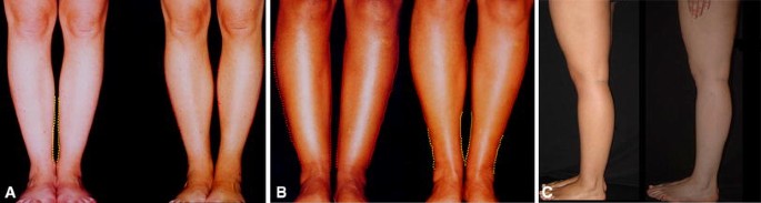 The Benslimane's Artistic Model for Leg Beauty | SpringerLink