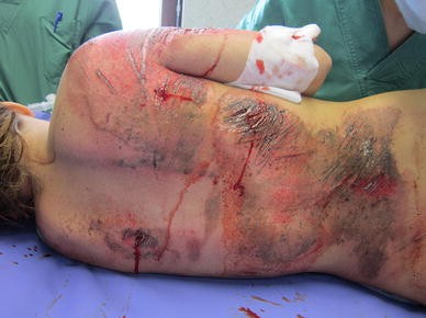 road rash pain